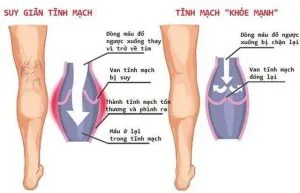 chua-suy-gian-tinh-mach-chan