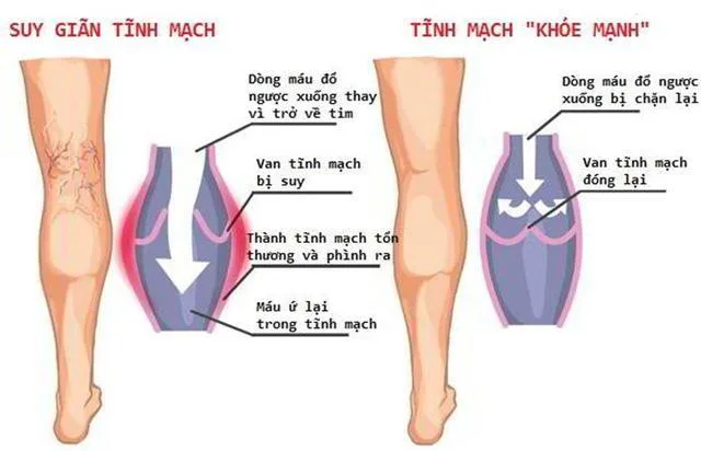 Những điều cần biết về việc chữa trị suy giãn tĩnh mạch chân