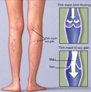 Khám và điều trị giãn tĩnh mạch chân ở đâu ?
