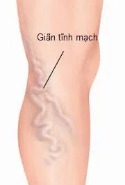 Những điều mọi người nên làm để điều trị suy giãn tĩnh mạch chân