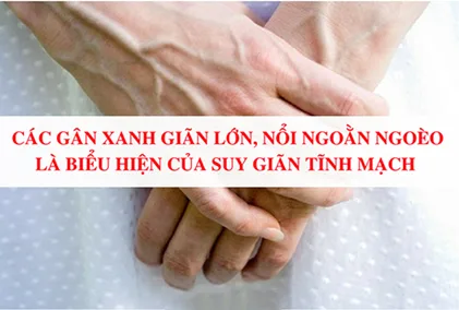 Điều trị giãn tĩnh mạch tay và những điều bạn cần biết