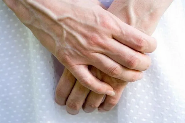 GIÃN TĨNH MẠCH TAY – HIỂU ĐÚNG ĐỂ PHÒNG VÀ CHỮA BỆNH