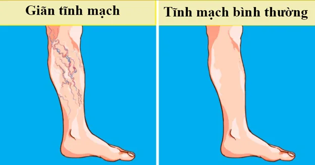 Bài tập thể dục cho người giãn tĩnh mạch hiệu quả