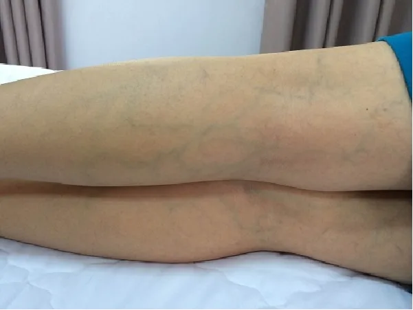 Cách điều trị bệnh giãn tĩnh mạch chân tốt nhất