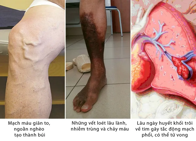 Cách điều trị bệnh suy giãn tĩnh mạch chân