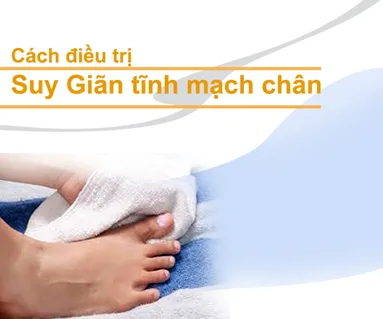Cách chữa suy giãn tĩnh mạch chân và những điều bạn cần biết