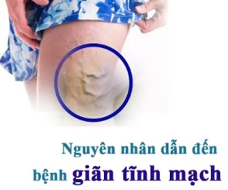 Những nguyên nhân giãn tĩnh mạch mà bạn cần biết để phòng tránh