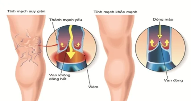 Phương pháp điều trị giãn tĩnh mạch chân hiệu quả