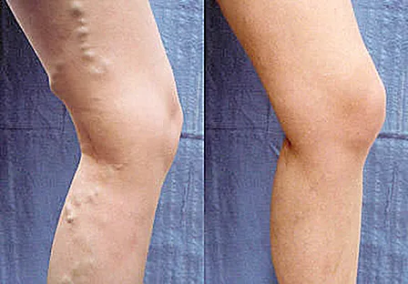 Suy giãn tĩnh mạch chi dưới - bệnh có thể chữa trị