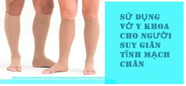 Điều trị giãn tĩnh mạch và những điều cần biết