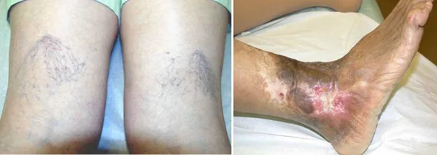 Bạn đã biết nguyên nhân gây giãn tĩnh mạch chân