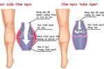 Bệnh giãn tĩnh mạch là gì?