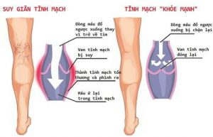 Bệnh giãn tĩnh mạch là gì?