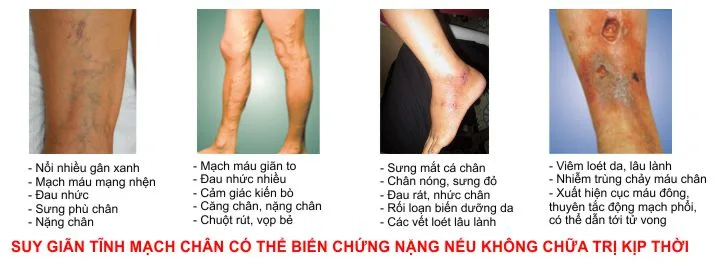 Những triệu chứng thường gặp của bệnh suy giãn tĩnh mạch
