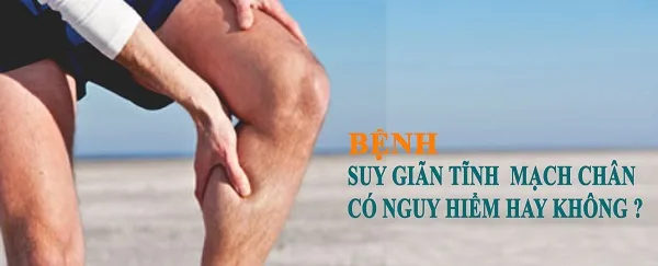 Bệnh giãn tĩnh mạch có nguy hiểm không