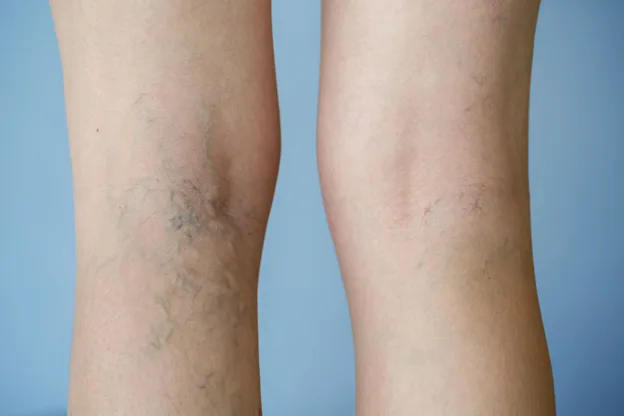Đôi lời bác sỹ nói về bệnh giãn tĩnh mạch chân