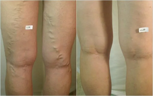 Đôi lời tâm sự về bệnh suy giãn tĩnh mạch