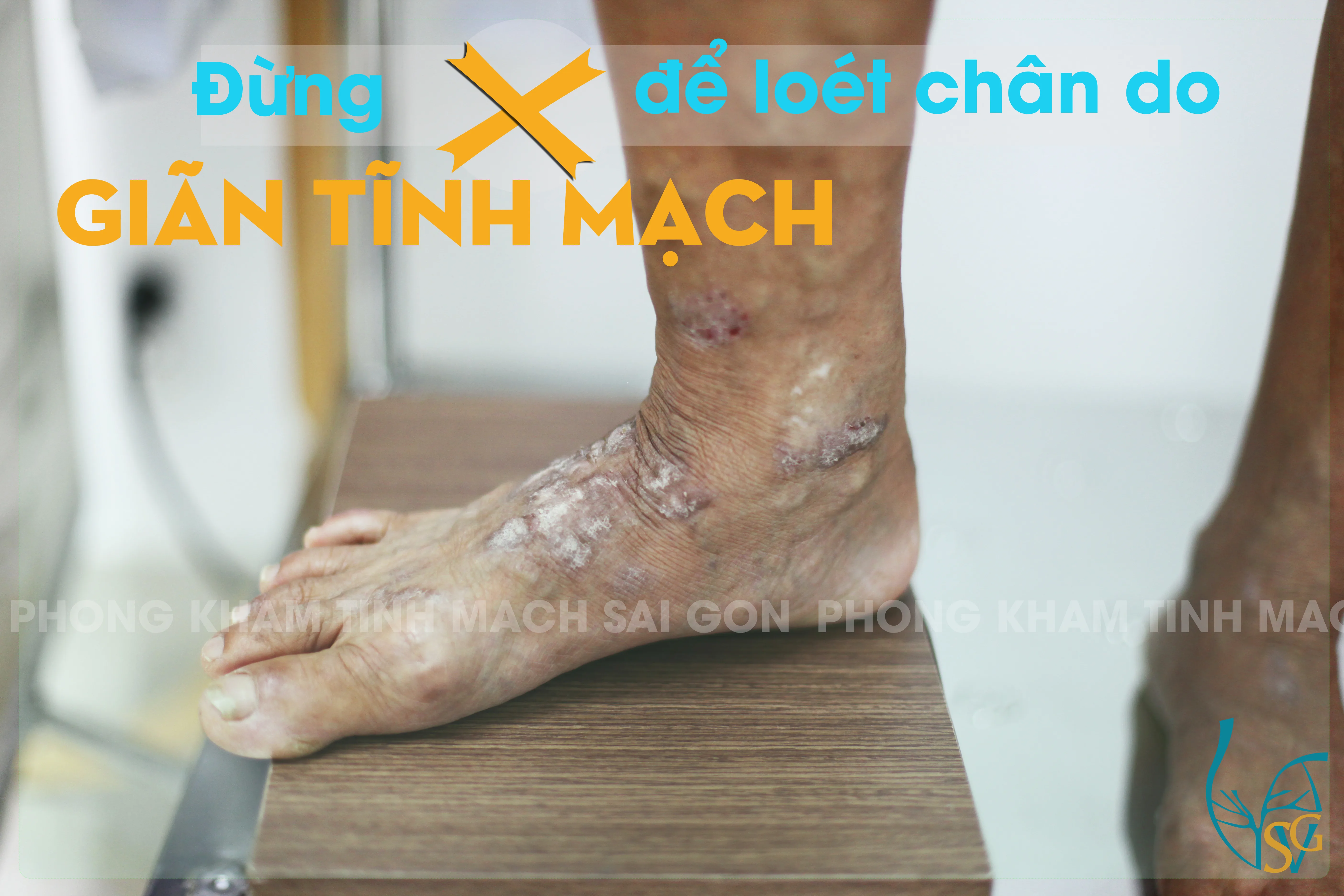 Đừng để loét chân do giãn tĩnh mạch