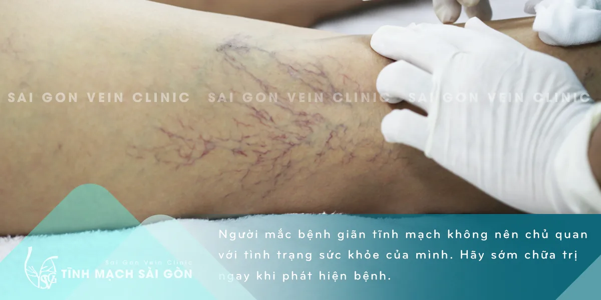Khi nào cần chữa trị bệnh giãn tĩnh mạch ?