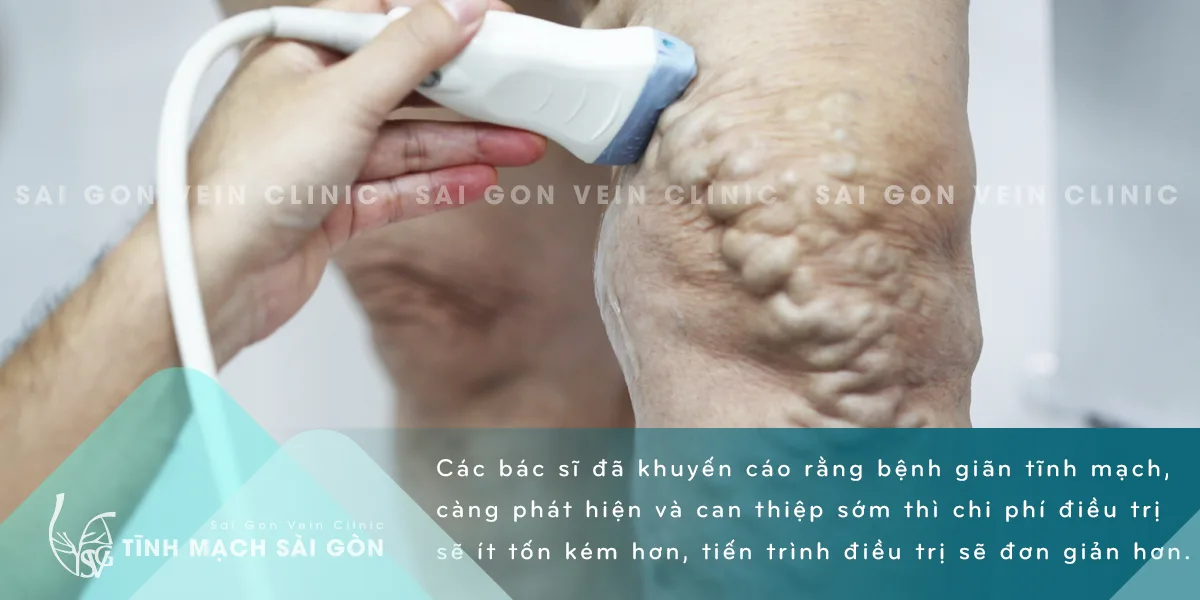 Giãn tĩnh mạch chân – nguyên nhân và cách điều trị