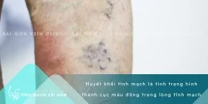 TM - HUYETKHOI20072021