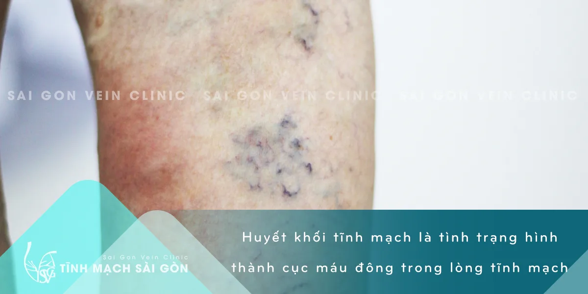 Phòng tránh tình trạng huyết khối tĩnh mạch