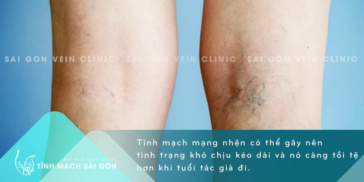 Tĩnh mạch mạng nhện – nguyên nhân và cách chữa trị