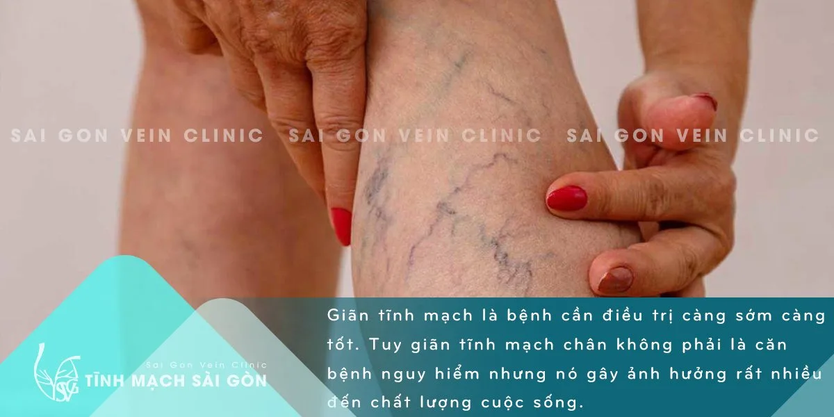 Khi nào nên điều trị bệnh giãn tĩnh mạch chân ?
