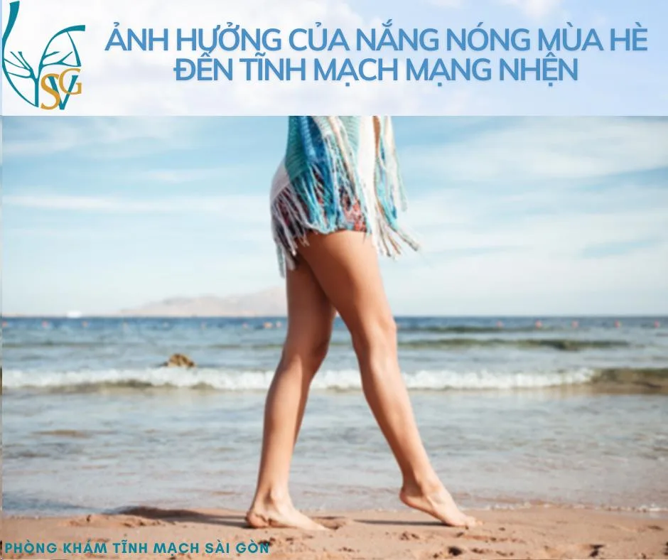 Ảnh hưởng của nắng nóng mùa hè đến tĩnh mạch mạng nhện