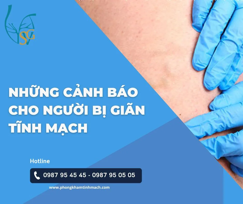 Những cảnh báo cho người bị giãn tĩnh mạch