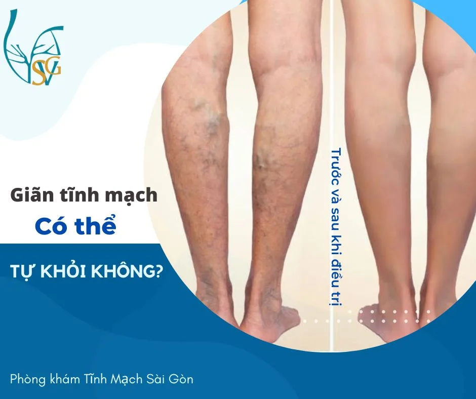 Bệnh giãn tĩnh mạch có thể tự khỏi hay không?