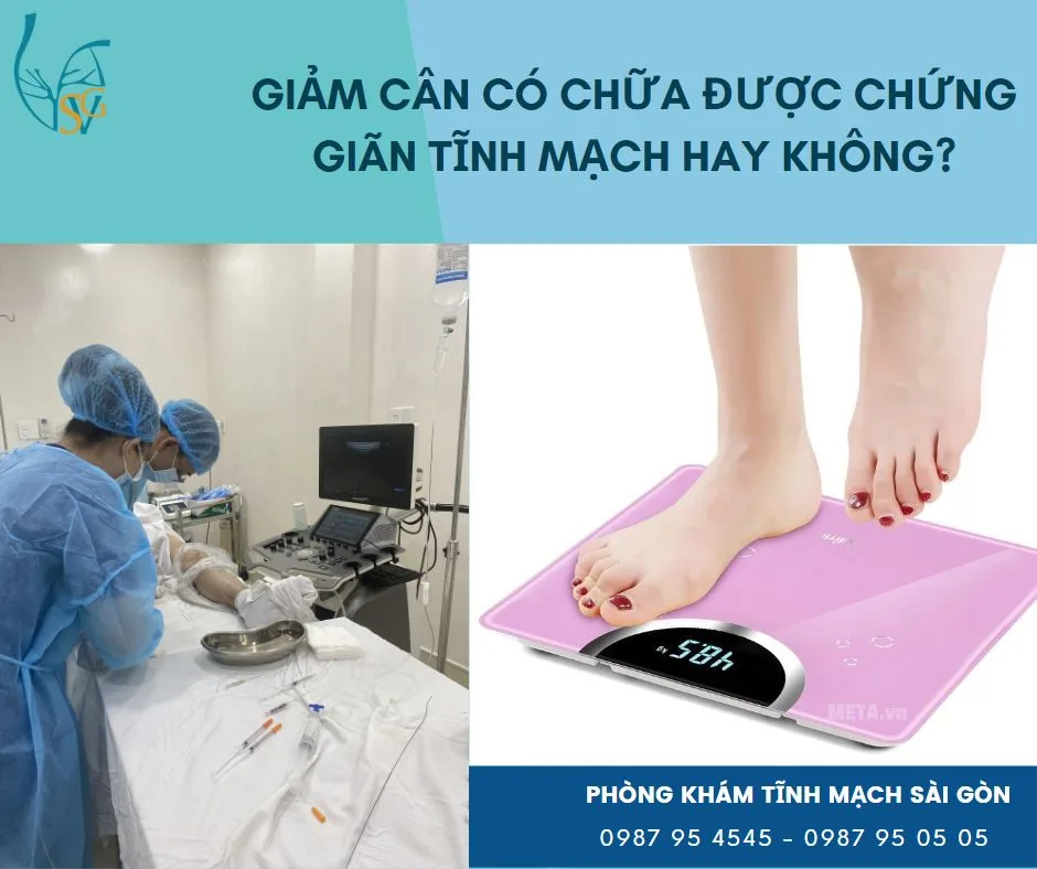 Giảm cân có chữa khỏi chứng giãn tĩnh mạch hay không?