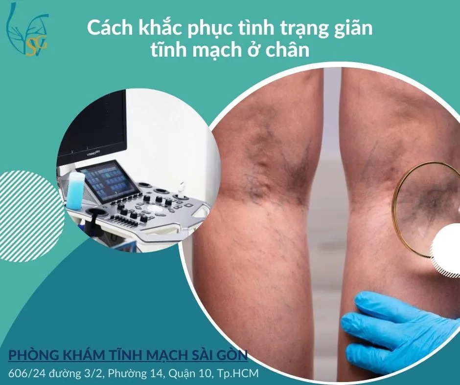 Cách khắc phục tình trạng giãn tĩnh mạch ở chân