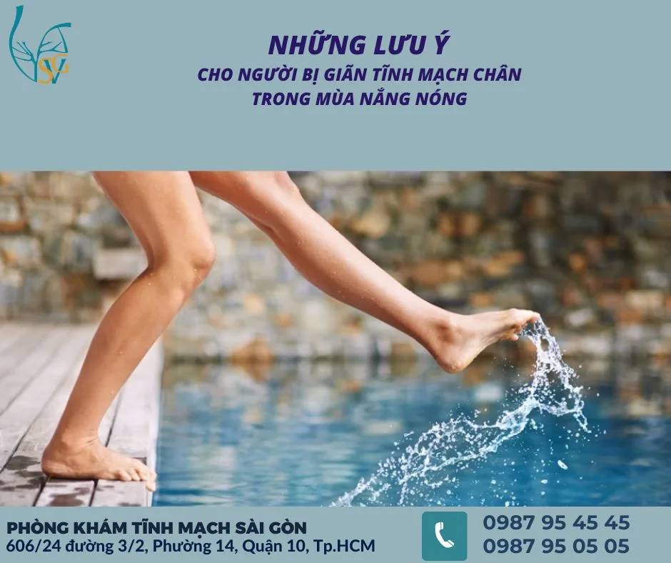 Cách chăm sóc chân bị giãn tĩnh mạch trong mùa nắng nóng