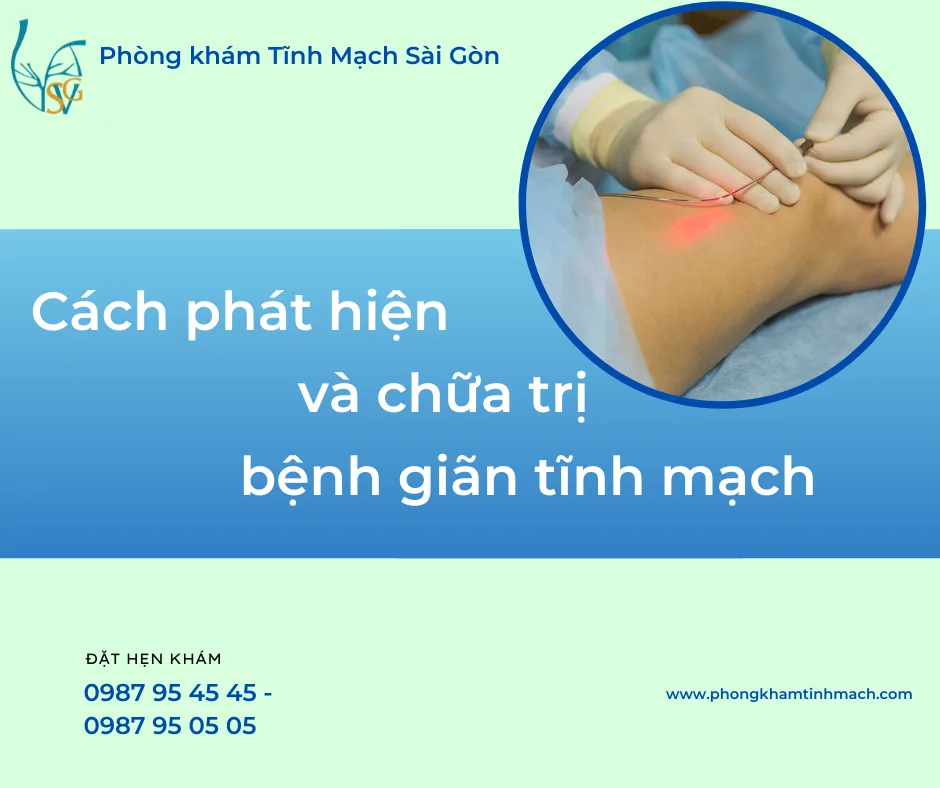 Cách phát hiện bệnh giãn tĩnh mạch