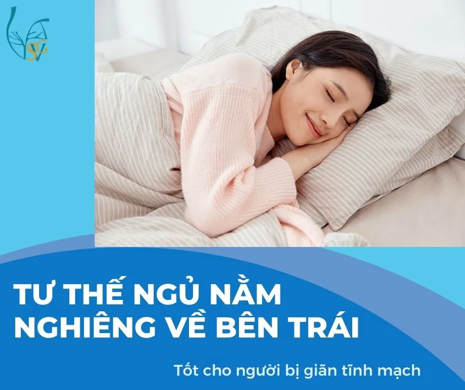 Tư thế ngủ nằm nghiêng về bên trái tốt cho người bị giãn tĩnh mạch