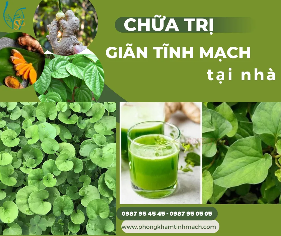Chữa trị giãn tĩnh mạch tại nhà bằng thảo dược