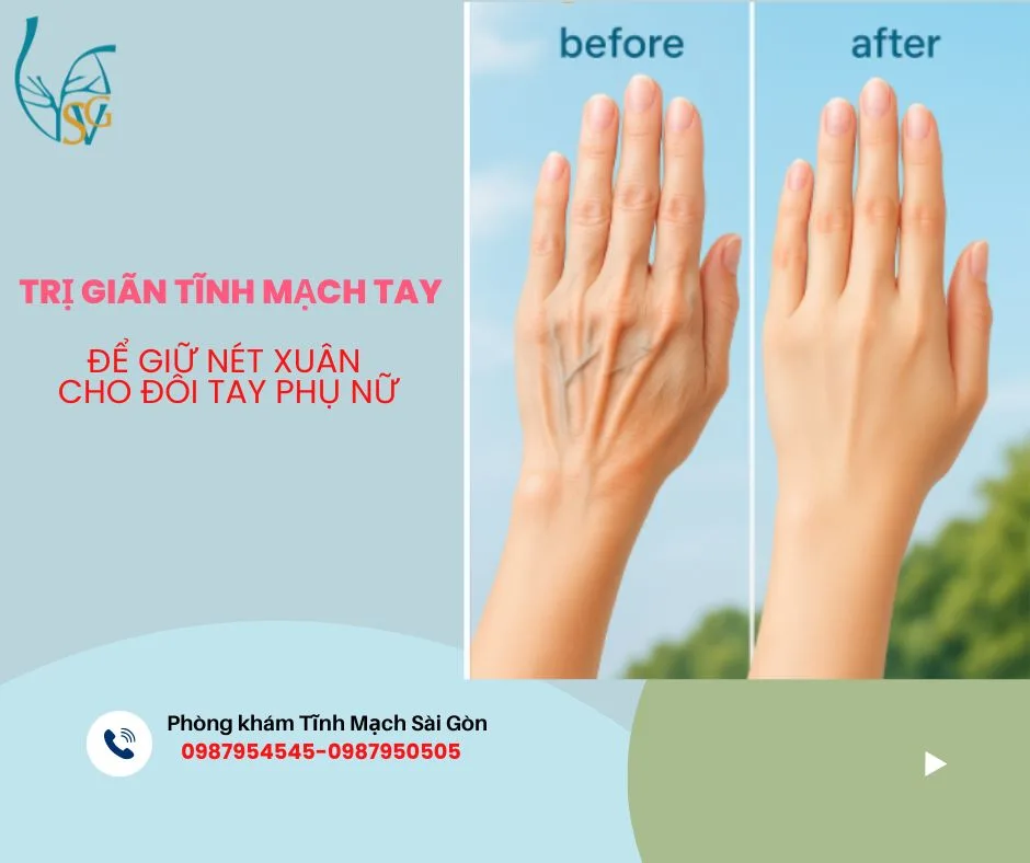 Giãn Tĩnh Mạch Tay: Giải Pháp Hiệu Quả Để Giữ Đôi Tay Trẻ Đẹp