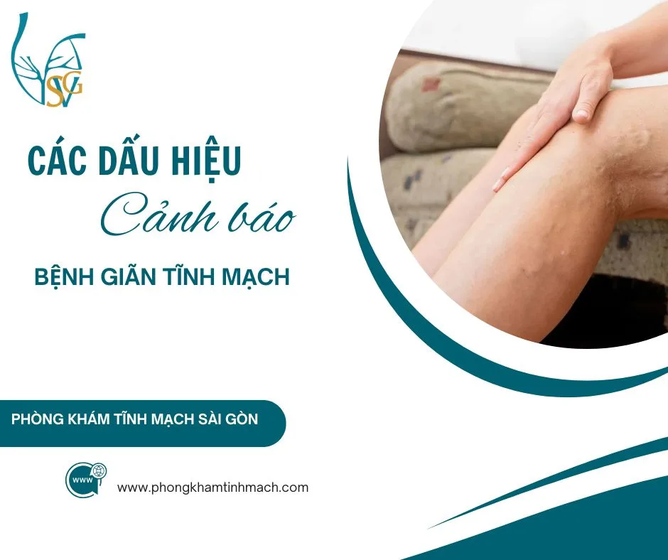 Những Dấu Hiệu Cảnh Báo Bệnh Giãn Tĩnh Mạch